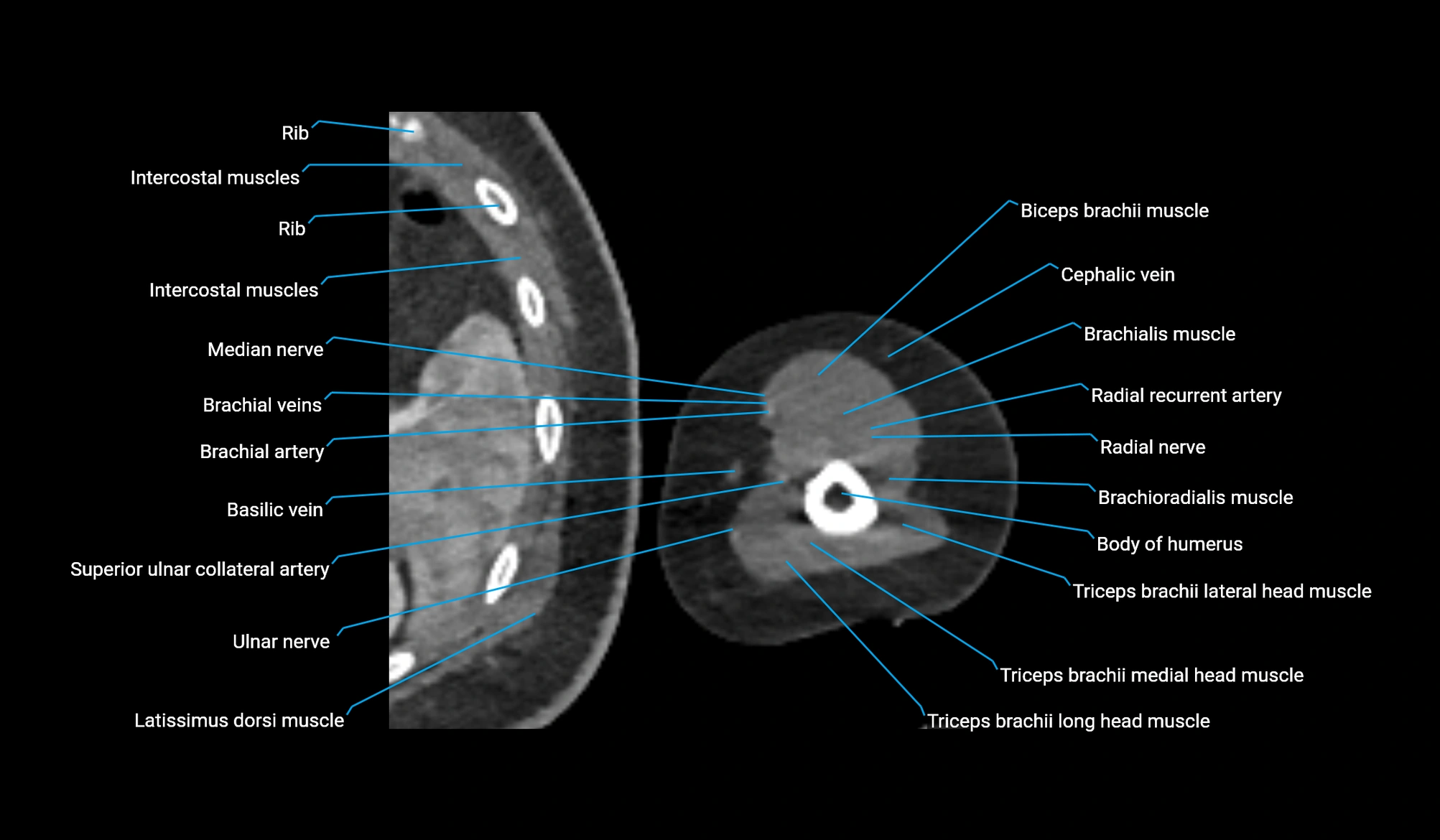 CT upper arm axial  cross sectional anatomy labelled radiology image -00316.webp